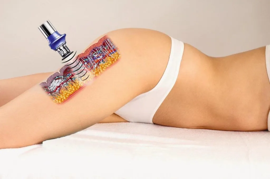 acoustic shockwave therapy for cellulite