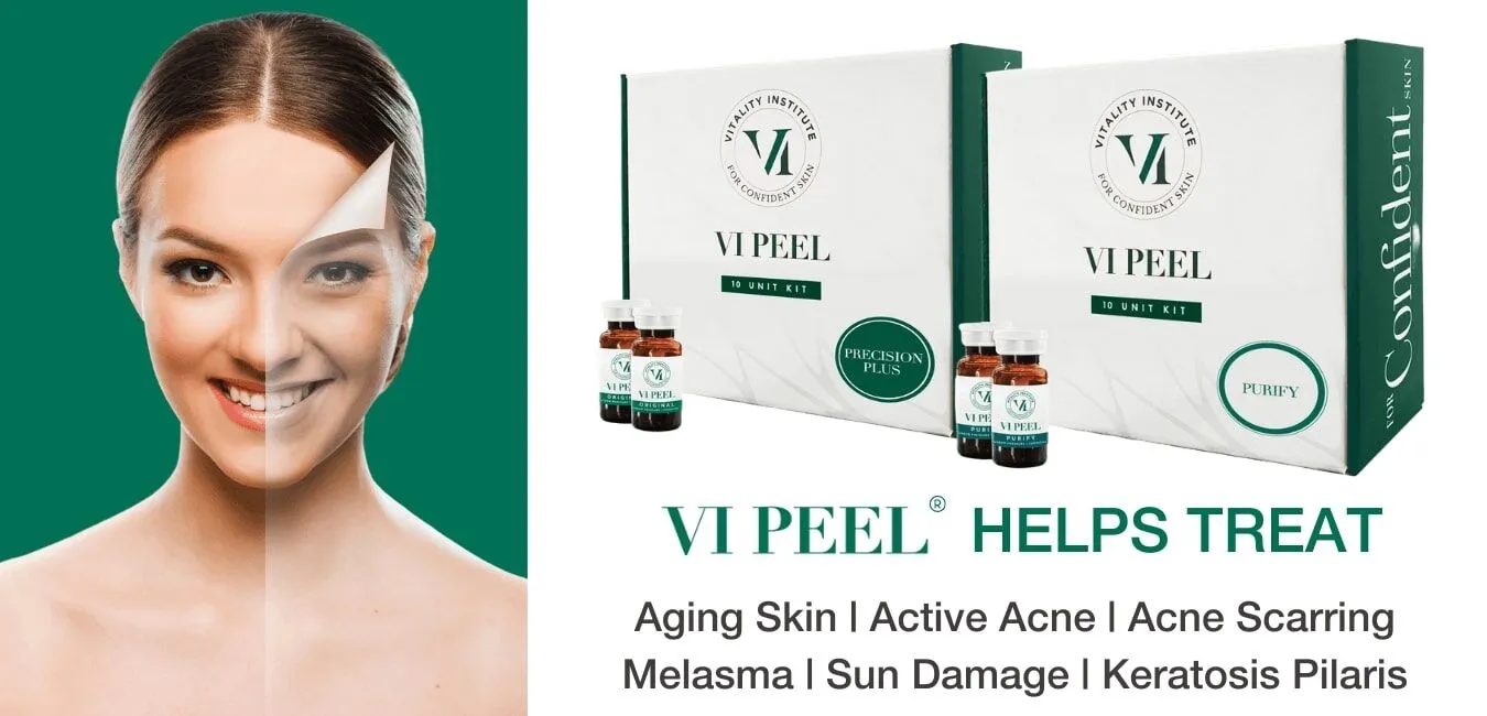 Vi Peel Treatment