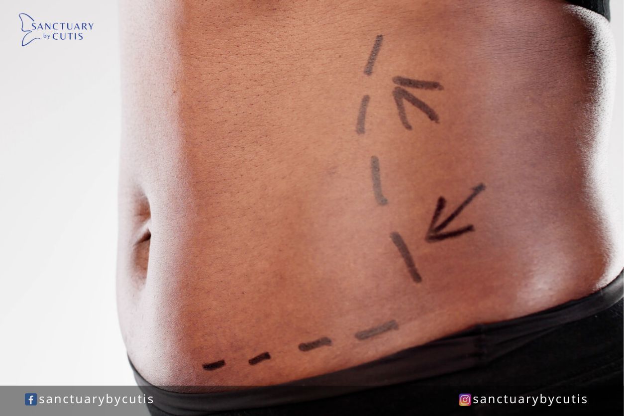 Non-Invasive Body Contouring in Singapore Benefits, Options, & What to Expect