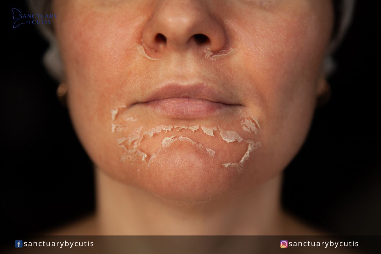 how does a chemical peel work